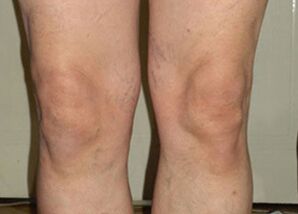 Po kúře používání Osteflexu jsou klouby zpět do normálu