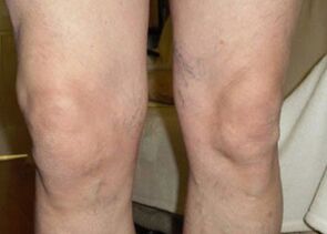 Před použitím Osteflexu byla Nilsova kolena na konci dne oteklá.